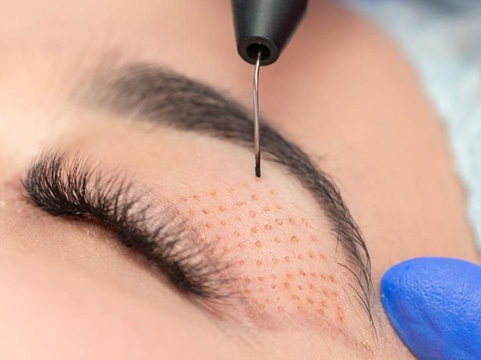 Fibroblast plasma pen skin tightening treatment around the eye